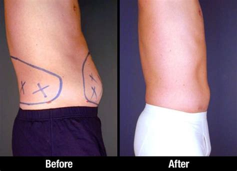 Lipo Waist Procedure Steps