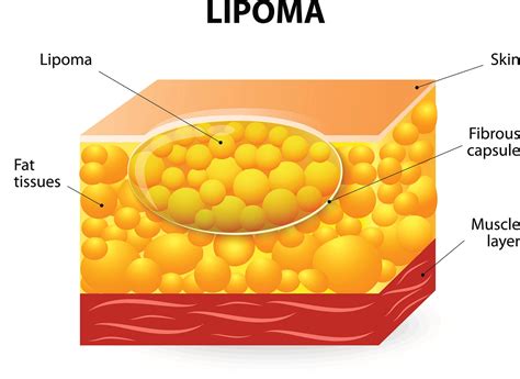 Lipoma on the skin