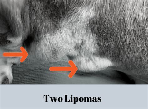 Final thoughts on lipomas