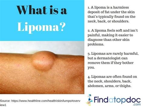 Lipoma Health and Wellness in Dogs