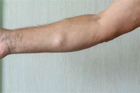 Lipoma on the arm