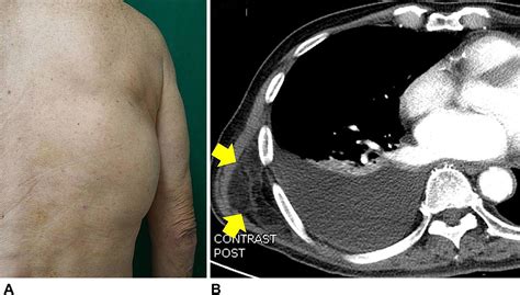 Lipoma on the chest