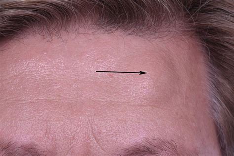 Lipoma on the forehead