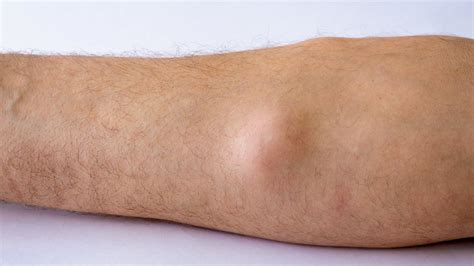 Lipoma on the leg