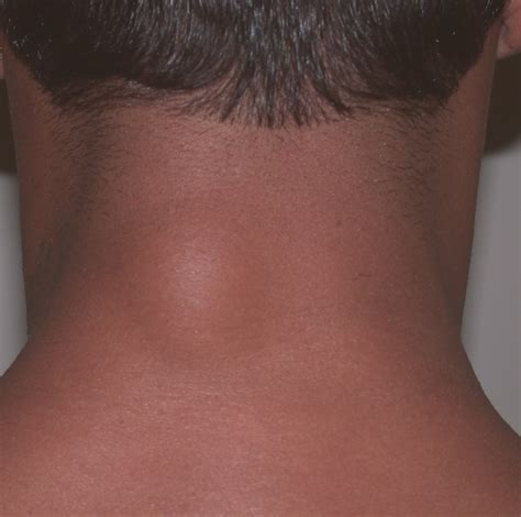 Lipoma on the neck