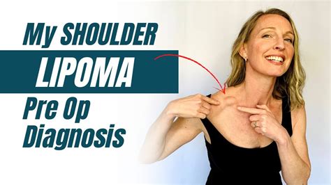 Lipoma on the shoulder