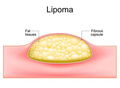 Lipoma pictures for identification