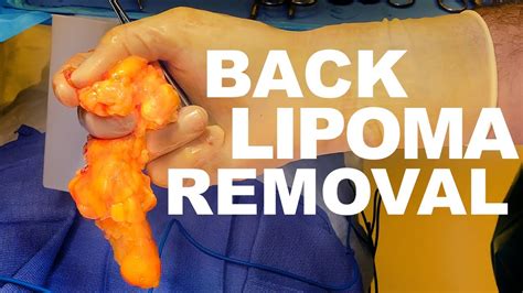 Description of Lipoma Removal Methods