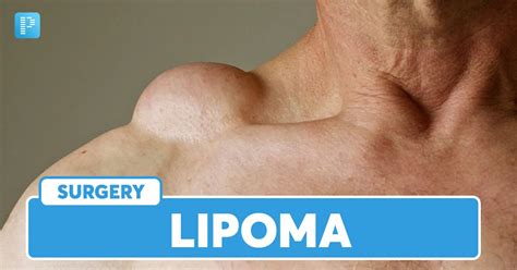 Symptoms of lipoma