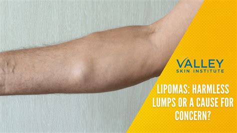 Symptoms of lipoma