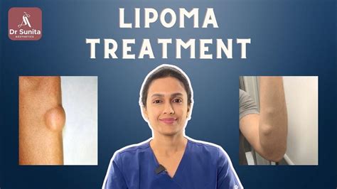 Lipoma Treatment Options