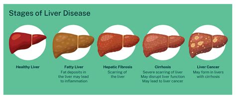 Living with liver disease