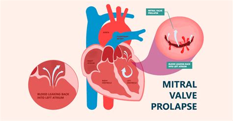 Living with Mitral Valve Prolapse