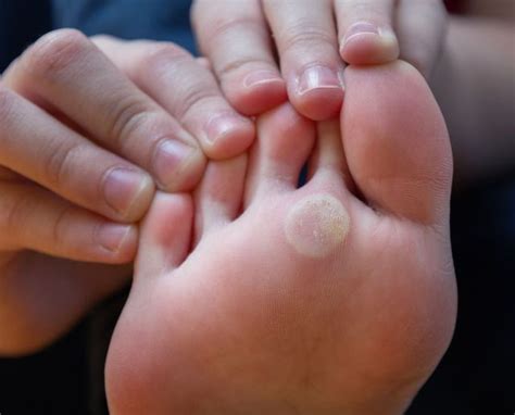 Living with Plantar Warts Image