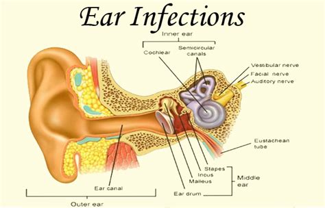 Long-Term Effects of Ear Infections