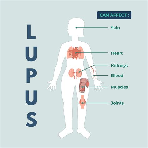 Lupus symptoms and diagnosis