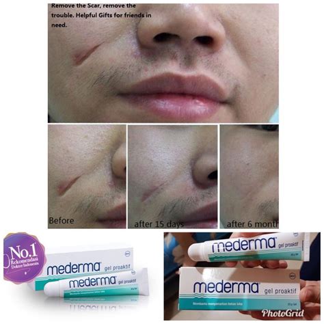 Mederma Before and After