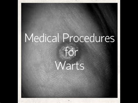 Medical Procedures for Warts