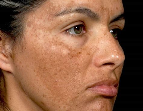 Melasma Causes