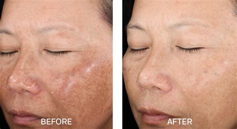 Melasma Chemical Peels