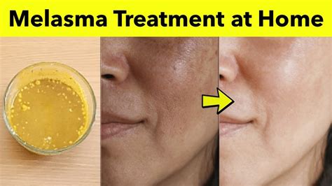 Melasma home remedies