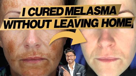 Home treatment options for melasma