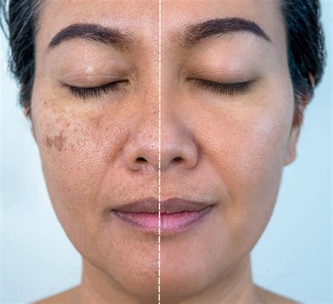 Lifestyle changes for managing melasma