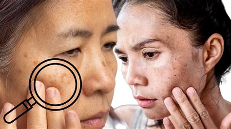 Melasma Management