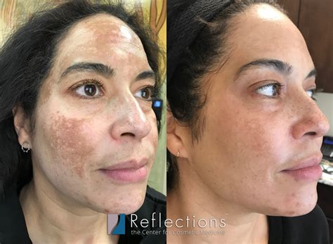 Medical treatment options for melasma