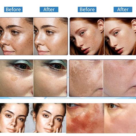 Melasma medical treatments