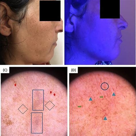 Melasma research