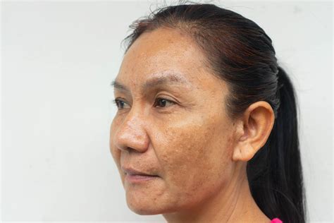 Melasma treatment outcomes