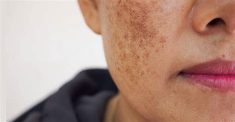 Melasma