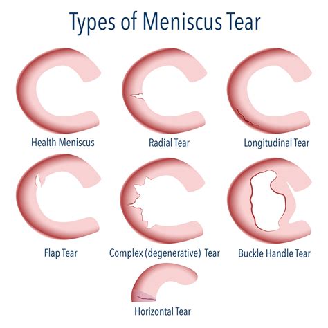 Meniscus injuries diagram