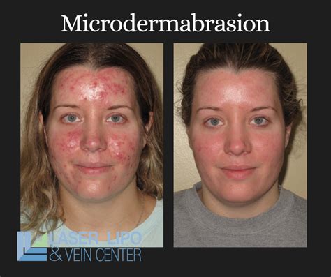 Microdermabrasion for Scars