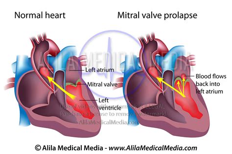 Mitral Valve Prolapse Causes