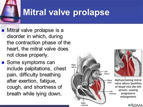 Mitral Valve Prolapse Management