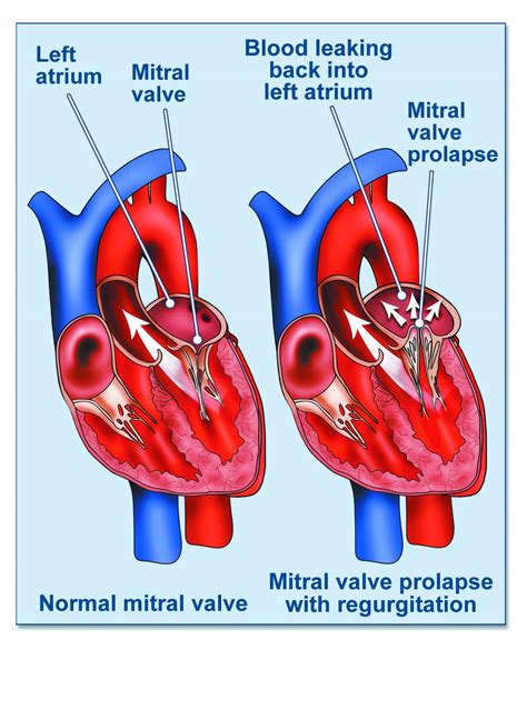 Mitral Valve Prolapse Risks