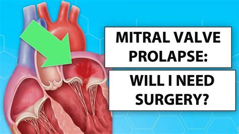 Mitral Valve Prolapse Treatment