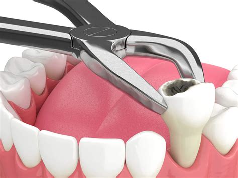 Molar extraction procedure