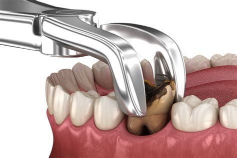 Molar extraction aftercare