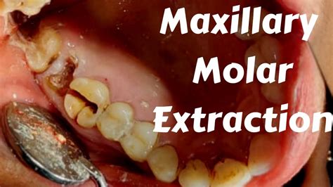 Molar extraction complications