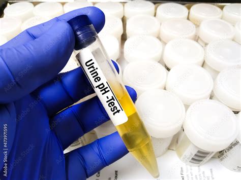 Monitoring Urine pH for Renal Calculi