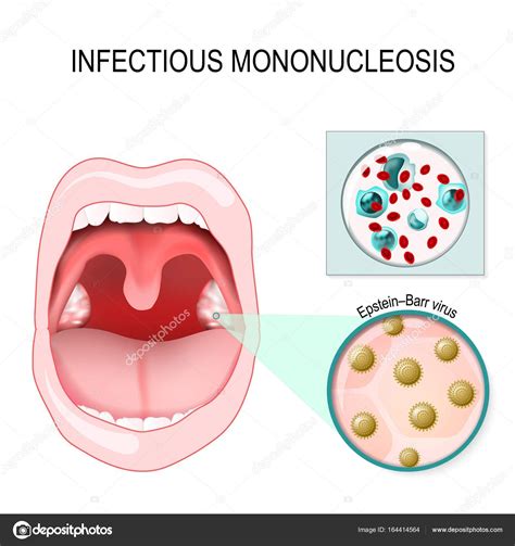 Description of Mononucleosis