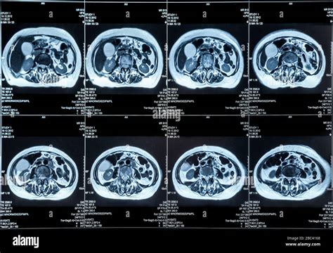 MRI abdomen scan image