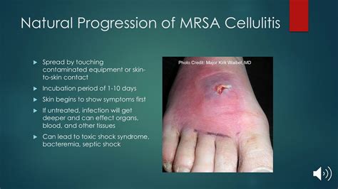 MRSA cellulitis education