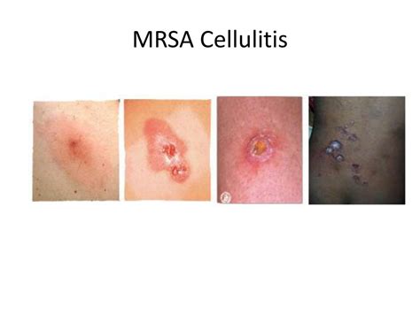 MRSA cellulitis symptoms