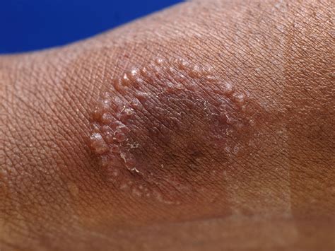 MRSA Skin Infection