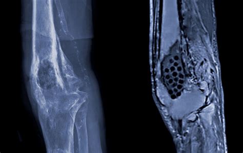 MRSA Osteomyelitis