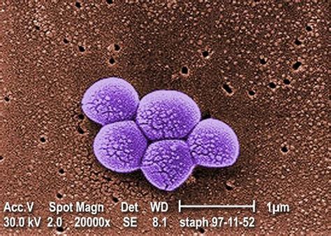 MRSA Pneumonia